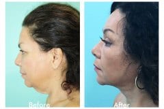 Facelift-Quiroz-Female-WFL012C