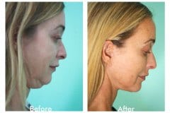 Facelift-Quiroz-Female-WFL012C