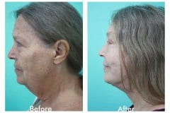 Facelift-Quiroz-Female-WFL012C