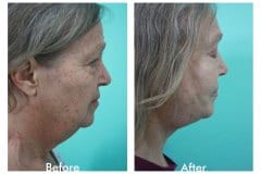 Facelift-Quiroz-Female-WFL012C