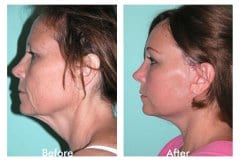 Facelift-Quiroz-Female-WFL012C