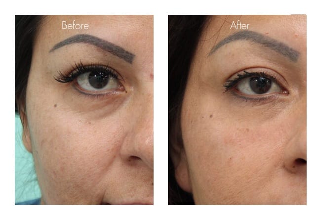 Facial Rejuvenation with Fillers
