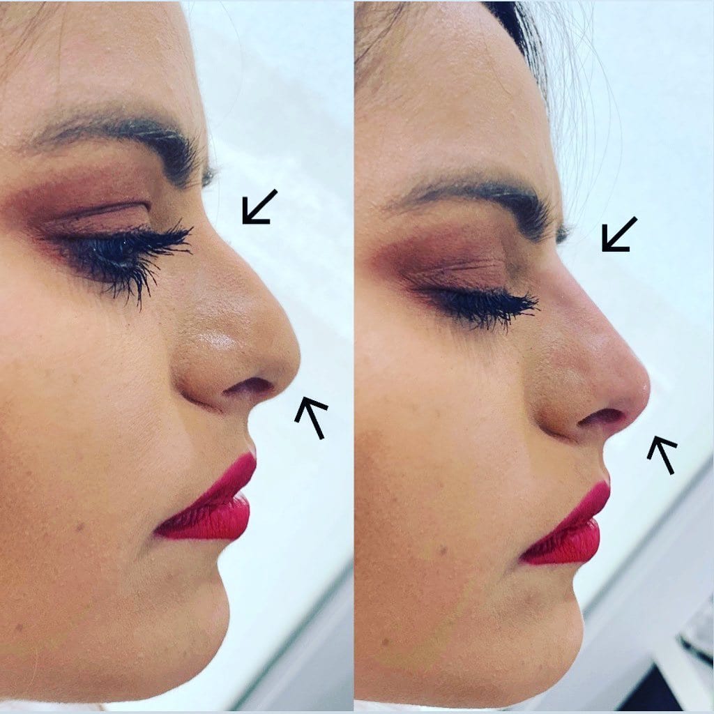 Before and after non-surgical rhinoplasty with fillers for women.br/ Time e...