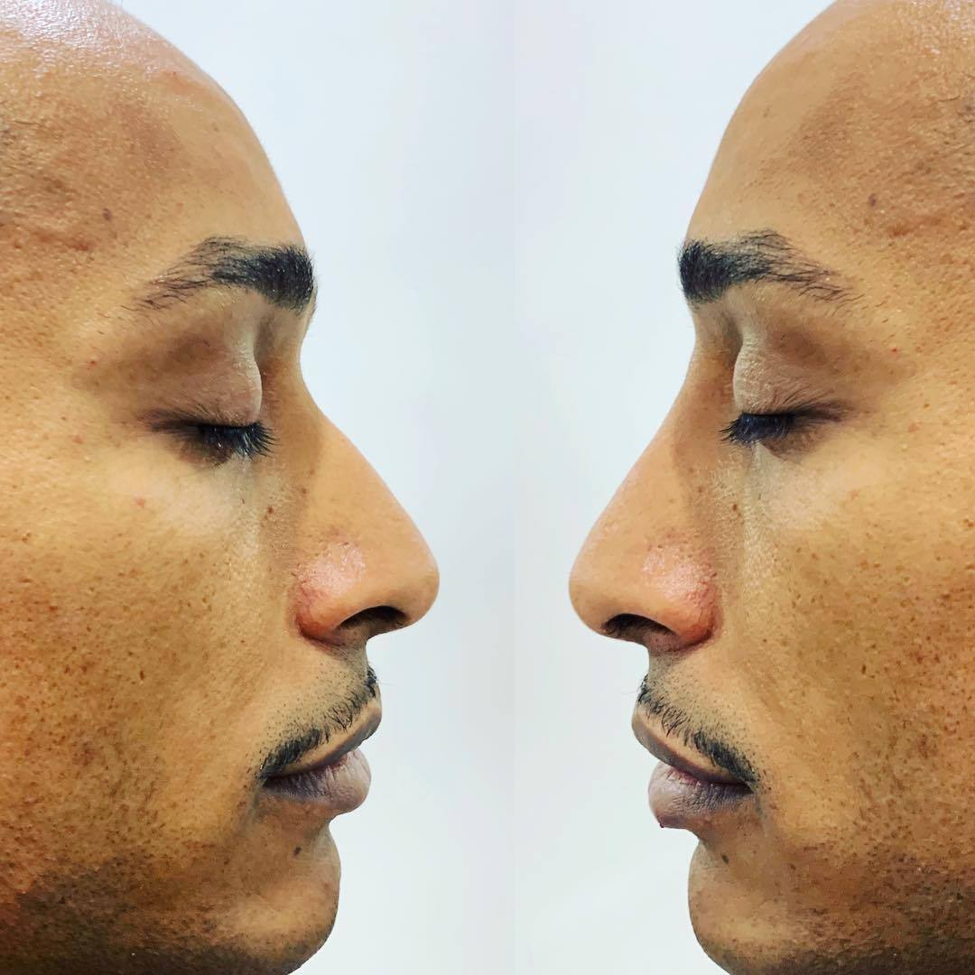 Non-Surgical rhinoplasty for men