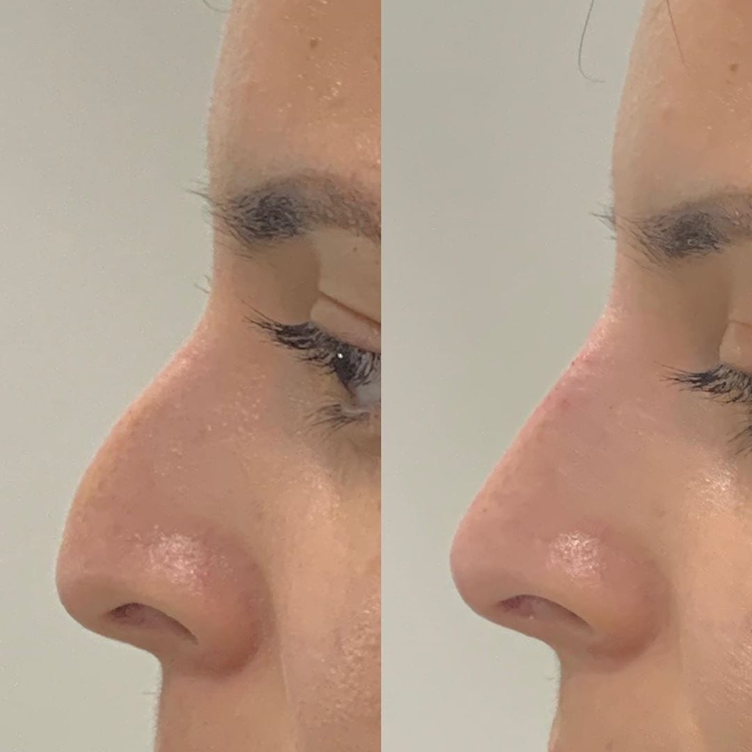 Non-Surgical rhinoplasty for women