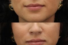 Facial fillers