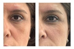 Lower eyelid bags treated with fillers