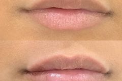 Lip fillers