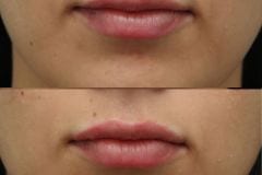 Lip fillers