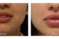 Lip fillers