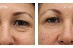 Lower eyelid bags treated with fillers