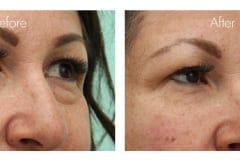 Lower eyelid bags treated with fillers