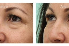 Lower eyelid bags treated with fillers