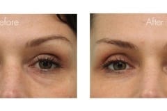 Lower eyelid bags treated with fillers