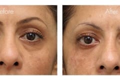 Lower eyelid bags treated with fillers