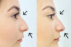 Non-Surgical rhinoplasty for women