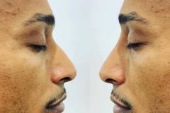 Non-Surgical rhinoplasty for men