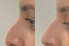Non-Surgical rhinoplasty for women