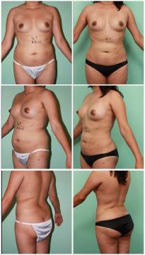 liposuction_001