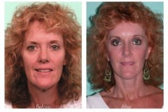 Female Neck lift