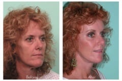 Female Neck lift