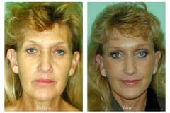 Female Neck lift