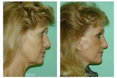 Female Neck lift