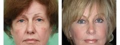 Female Neck lift