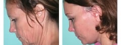 Female Neck lift