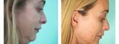 Female Neck lift