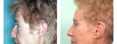 Female Neck lift