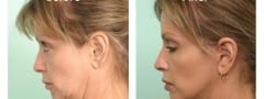 Female Neck lift