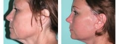 Female Neck lift