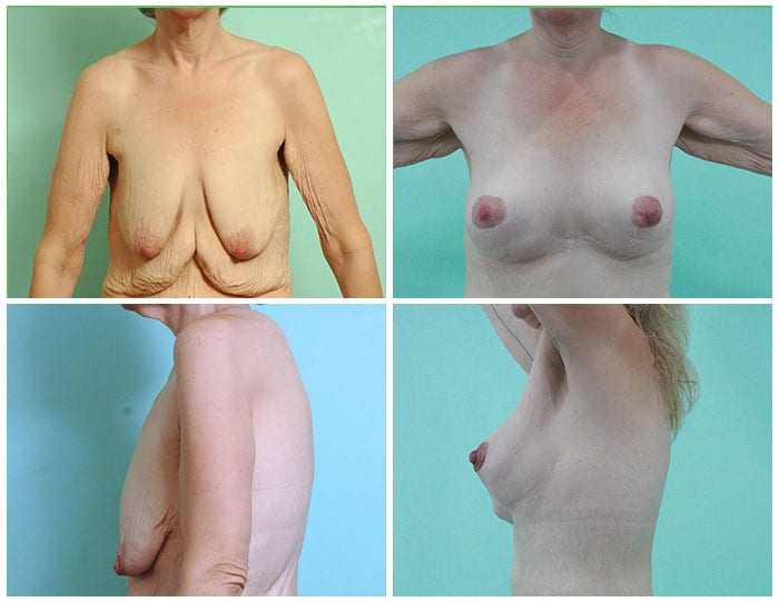 Breast Lift Revision Surgery