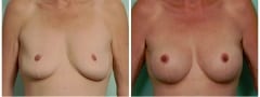 post-bariatric-breast-lift_002