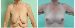 post-bariatric-breast-lift_002