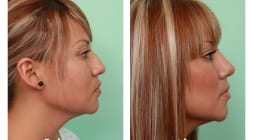 Female Rhinoplasty