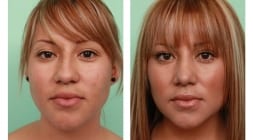 Female Rhinoplasty