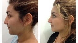 Female Rhinoplasty