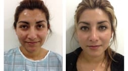 Female Rhinoplasty