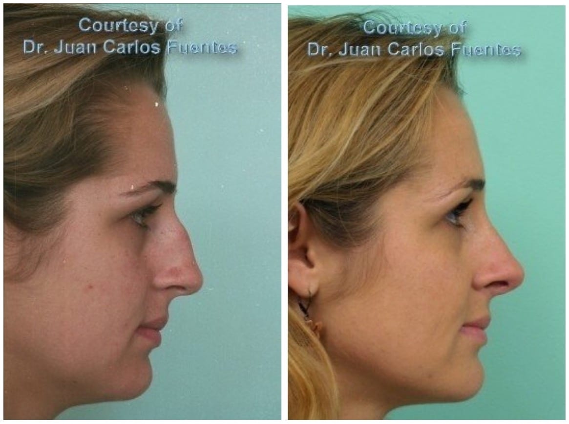 Female Rhinoplasty