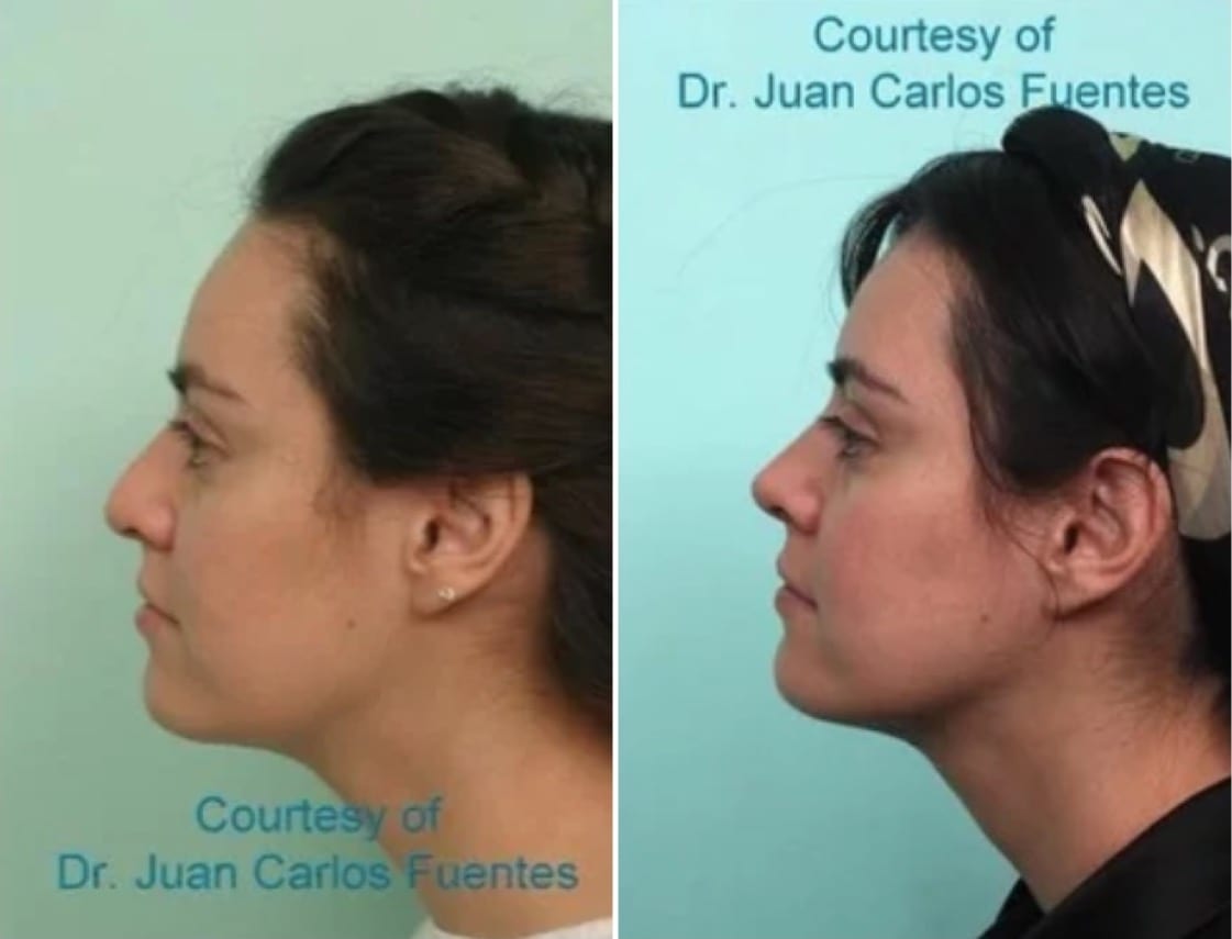 Female Rhinoplasty