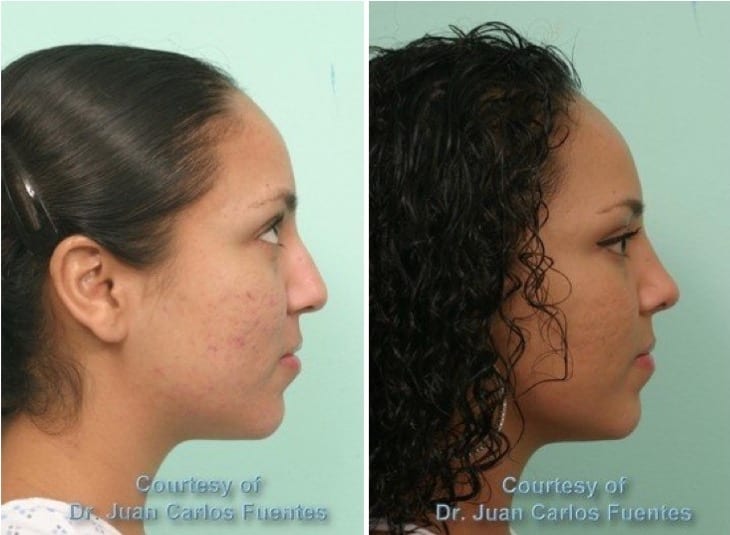 Female Rhinoplasty