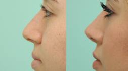 Female Rhinoplasty