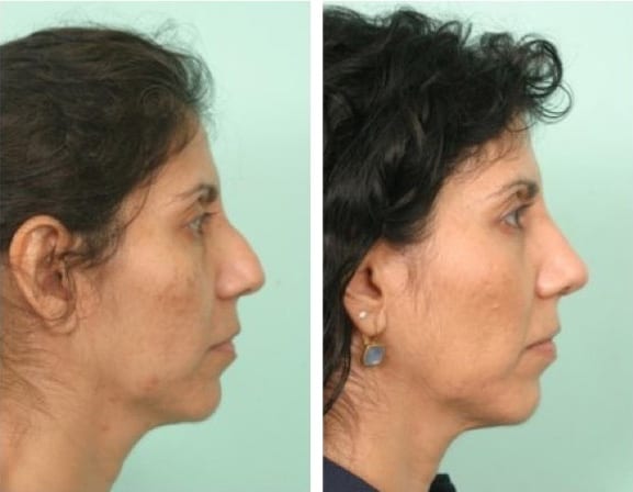 Female Rhinoplasty