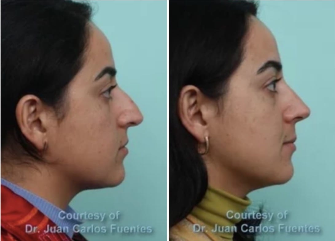 Female Rhinoplasty