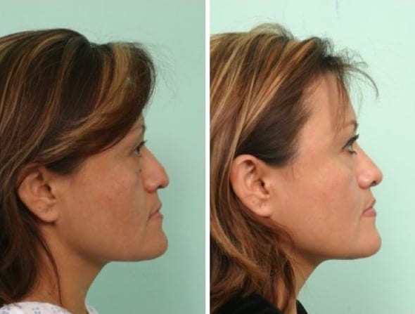 Female Rhinoplasty