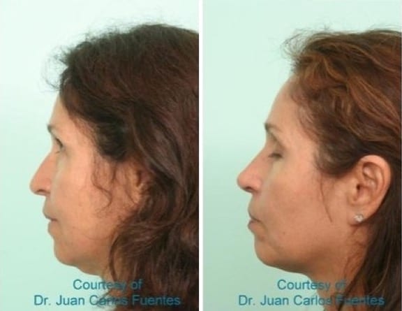 Female Rhinoplasty