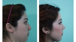 Female Rhinoplasty