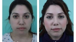 Female Rhinoplasty